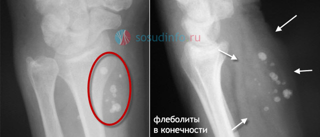 Флеболиты в малом тазу у мужчин - Все про холестерин