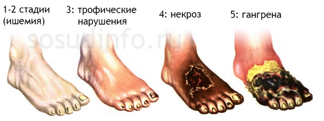 Облитерирующий эндартериит сосудов нижних конечностей - симптомы и лечение