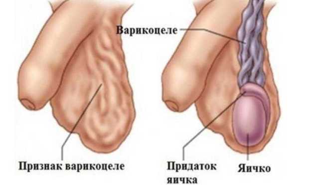 Проба и прием Вальсальвы: суть метода, сферы применения. Проба вальсальвы при варикоцеле положительная