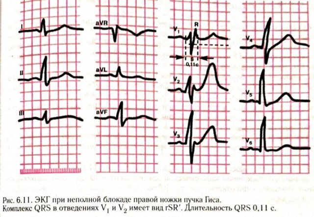 Блокада левой ножки пучка гиса на экг — Сердце