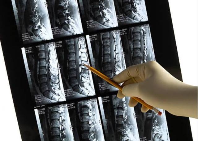 Инсульт спинного мозга (спинальный): симптомы, лечение, последствия