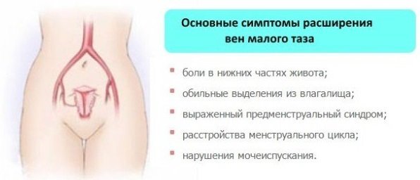 Варикозное расширение вен малого таза у женщин