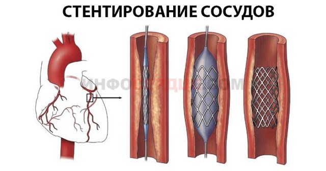 Аорта уплотнена - что это значит? Лечение уплотнения аорты