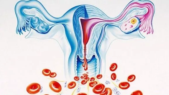 Как остановить маточное кровотечение в домашних условиях?