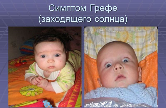 Внутричерепное давление у грудничков