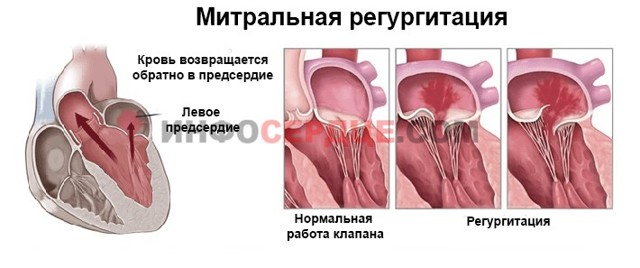 Трикуспидальная регургитация: степени, причины, лечение. Минимальная митральная регургитация что это такое