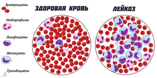 Острый миелобластный лейкоз прогноз жизни у взрослых