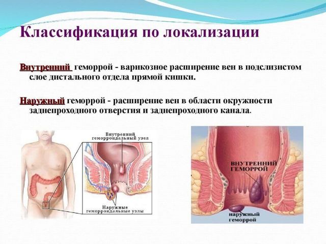 Геморрой при беременности - чем и как лечить геморрой беременной?