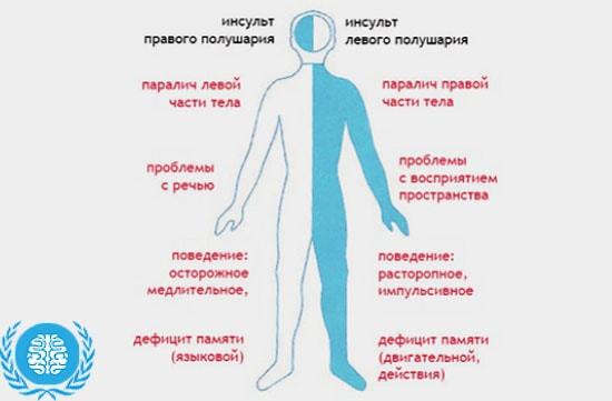 Инфаркт головного мозга - Мое Здоровье