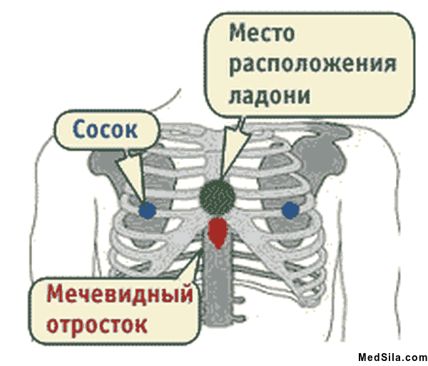 Алгоритм проведения сердечно-легочной реанимации. Основы сердечно-легочной реанимации