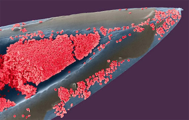 Анализ эритроцитов в крови человека. Норма и патологии