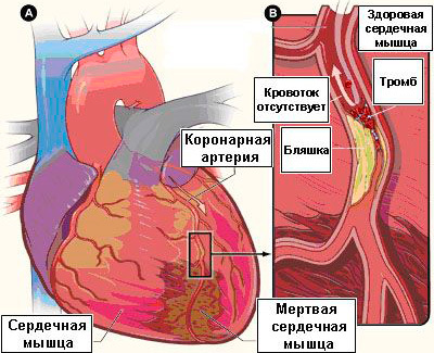 Тромб в сердце: что это такое, симптомы и что делать