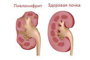 Боль под правой лопаткой сзади со спины (колющая, резкая, тупая): причины и лечение