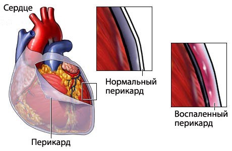 Ревматизм - причины, признаки, симптомы и лечение