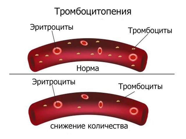 Тромбоцитопения - что это такое, причины возникновения, симптомы и лечение у детей и беременных