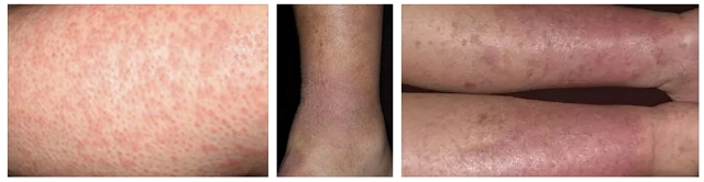 Варикозный дерматит нижних конечностей лечение народными средствами на сайте варикоз