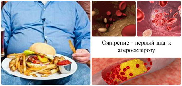 Повторный инсульт