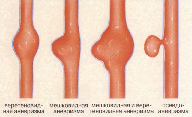 Аневризма головного мозга: что такое, почему возникает, группы риска, классификация, симптомы, осложнения, последствия, диагностика, лечение
