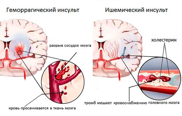 Ишемический инсульт головного мозга: прогноз для жизни у пожилых людей