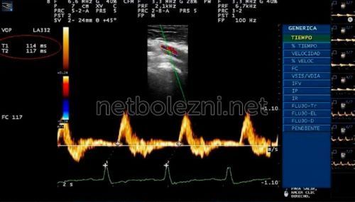 Тромб в ноге – причины, симптомы и лечение