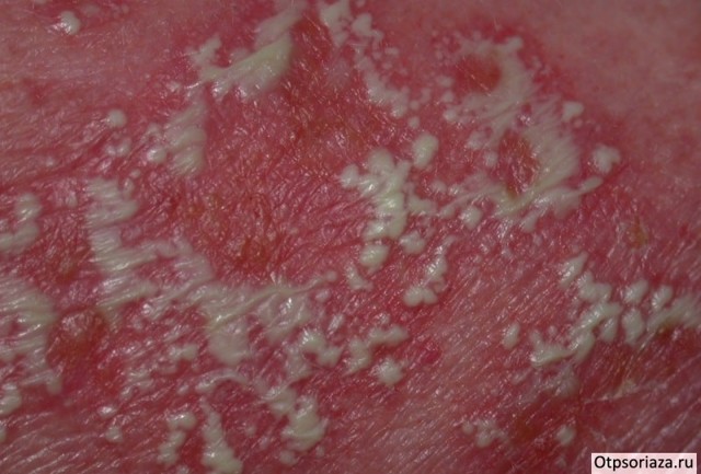Лечение псориаз на руках - фото, симптомы, виды псориаза на руках