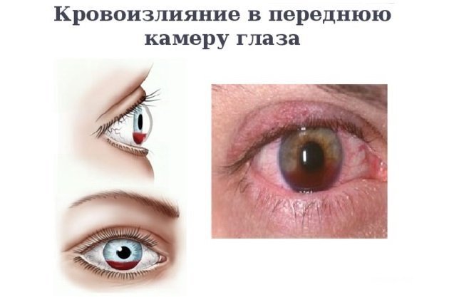 Кровоизлияние в глаз – причины, лечение, кровоизлияние после удара