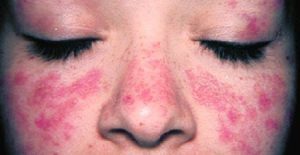 Системная красная волчанка при беременности. Системная красная волчанка и беременность