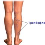 Гель Долобене: инструкция по применению, отзывы и цены