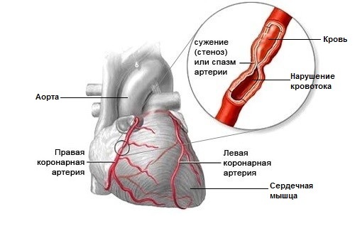 Самопомощь и неотложная помощь при стенокардии