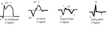 Инфаркт миокарда на ЭКГ: признаки, расшифровка