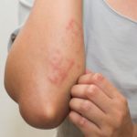 Для чего мазь Гиоксизон: от чего помогает, показания к применению и инструкция (цена, отзывы и аналоги)