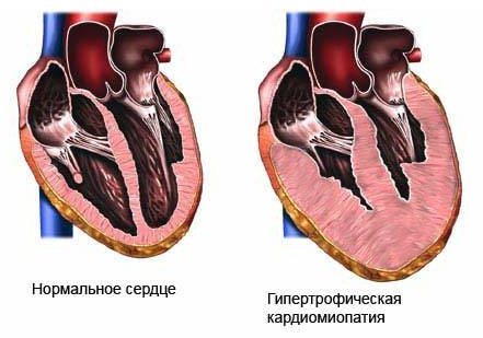 Прыгает сердце что это: диета, как проявляется, свечи, стадии