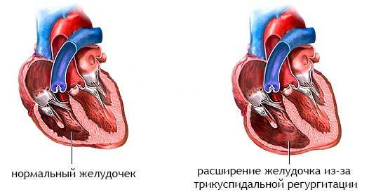 Регургитация трикуспидального клапана 1 степени