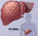 Цирроз печени: причины, признаки, симптомы и лечение