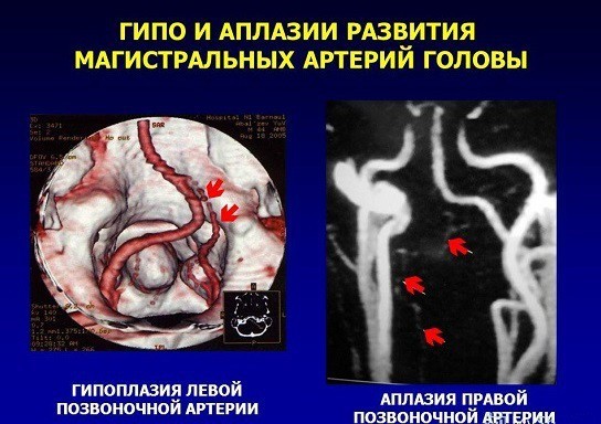 Гипоплазия правой позвоночной артерии