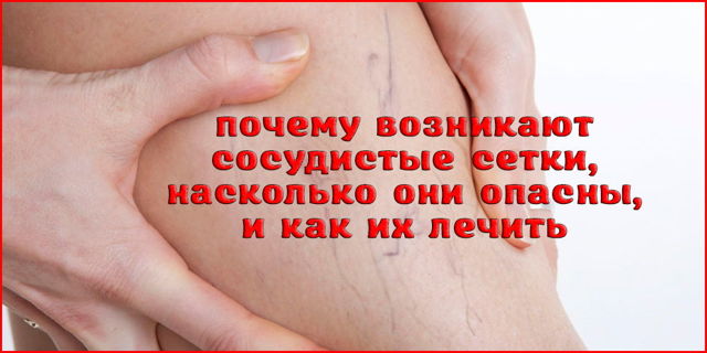 Капиллярная сетка – что это такое? Сосудистые звездочки на руках (купероз)