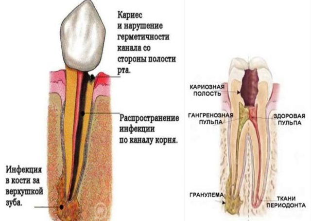 Гранулема на корне зуба: что это такое, симптомы, лечение в домашних условиях