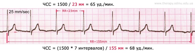 Онлайн-курс ЭКГ: ЧСС, способы ее подсчета
