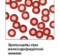 Железодефицитная анемия симптомы