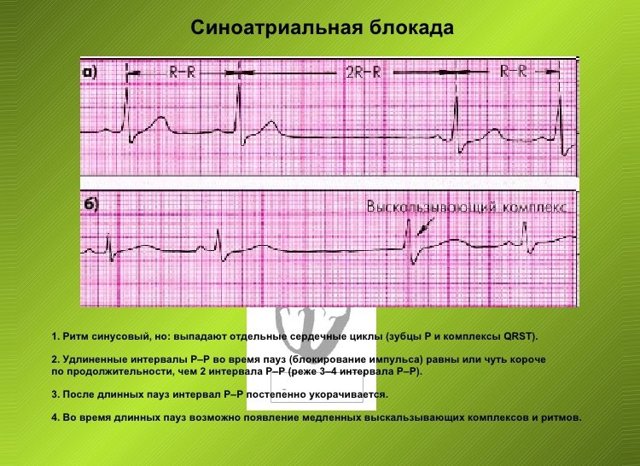 Синусовый ритм: что это в заключении ЭКГ, расшифровка и норма