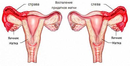 Воспаление придатков: причины, симптомы и лечение воспаления придатков у женщин