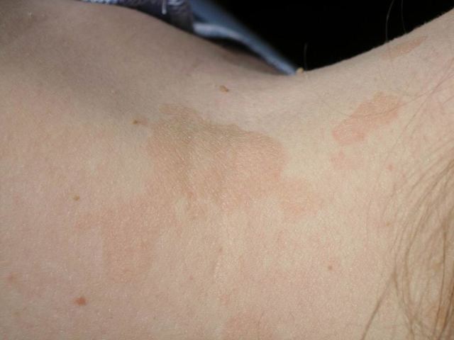 Разноцветный лишай: фото и лечение в домашних условиях