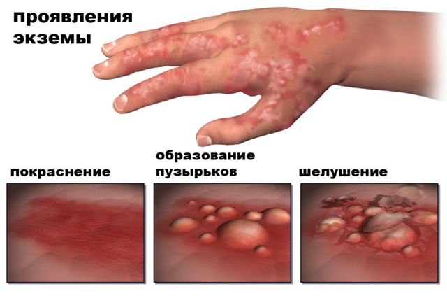 От чего помогает Стрептоцидовая мазь: отзывы, противопоказания, инструкция по применению