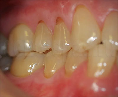 Пришеечный кариес - причины, симптомы, диагностика и лечение