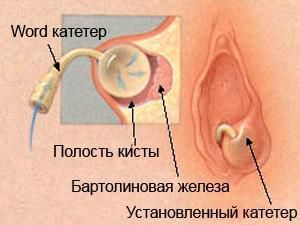 Бартолинит - причины, симптомы, диагностика и лечение