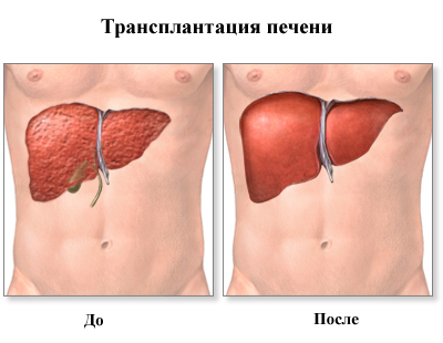 Пересадка печени: виды, выбор донора, ход процедуры.