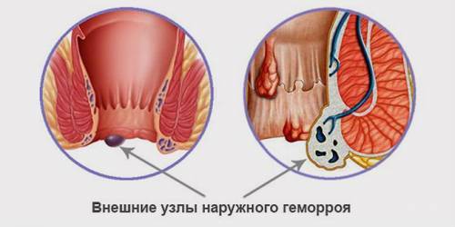 Выпал геморроидальный узел