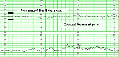 КТГ при беременности — расшировка, норма и когда делают?