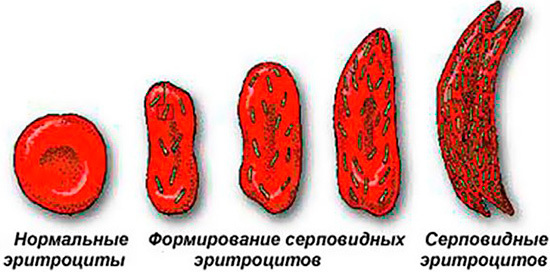 Серповидноклеточная анемия и типы ее наследования.