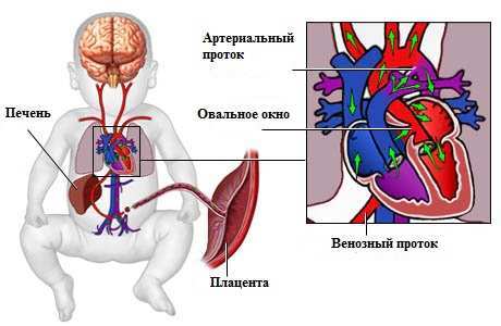 Открытое овальное окно в сердце у ребенка: у грудничка и новорожденного дырка в серце